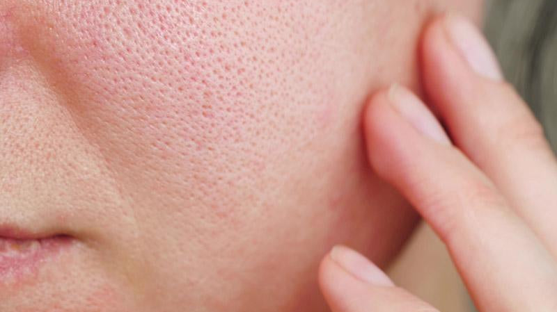 7 of the Best Treatments for Enlarged Pores - The Skin Boutique