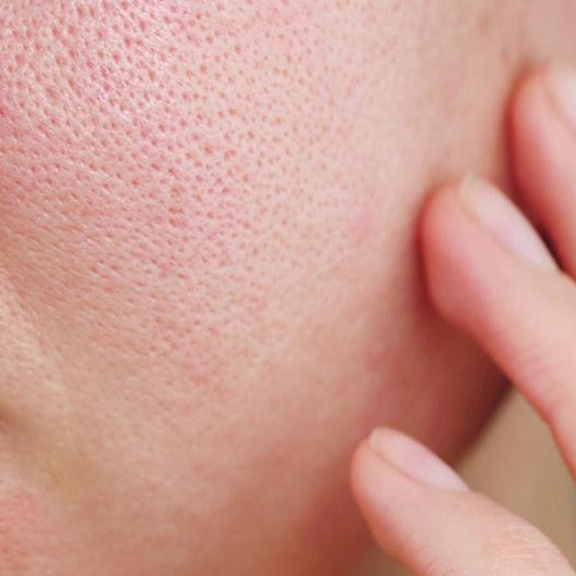 7 of the Best Treatments for Enlarged Pores - The Skin Boutique