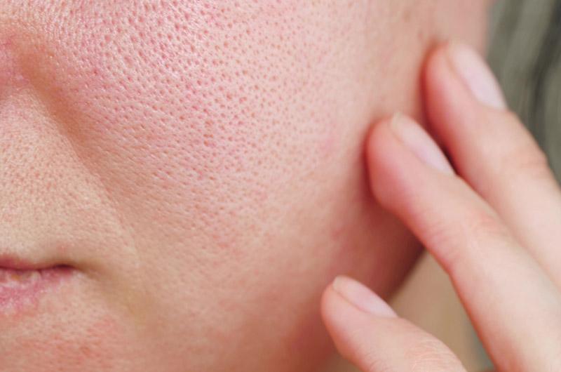 7 of the Best Treatments for Enlarged Pores - The Skin Boutique