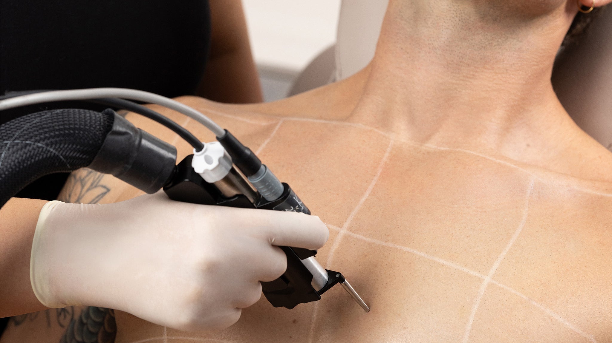 Laser Hair Removal in Sandringham & Bayside
