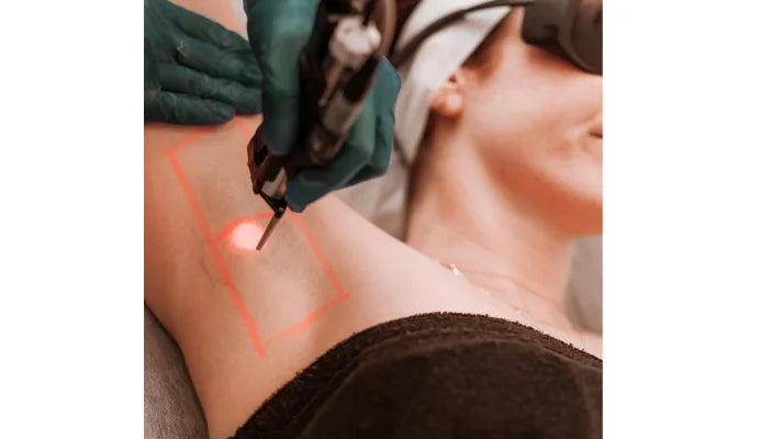 IPL vs Laser Hair Removal: Key Differences