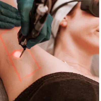 IPL vs Laser Hair Removal: Key Differences