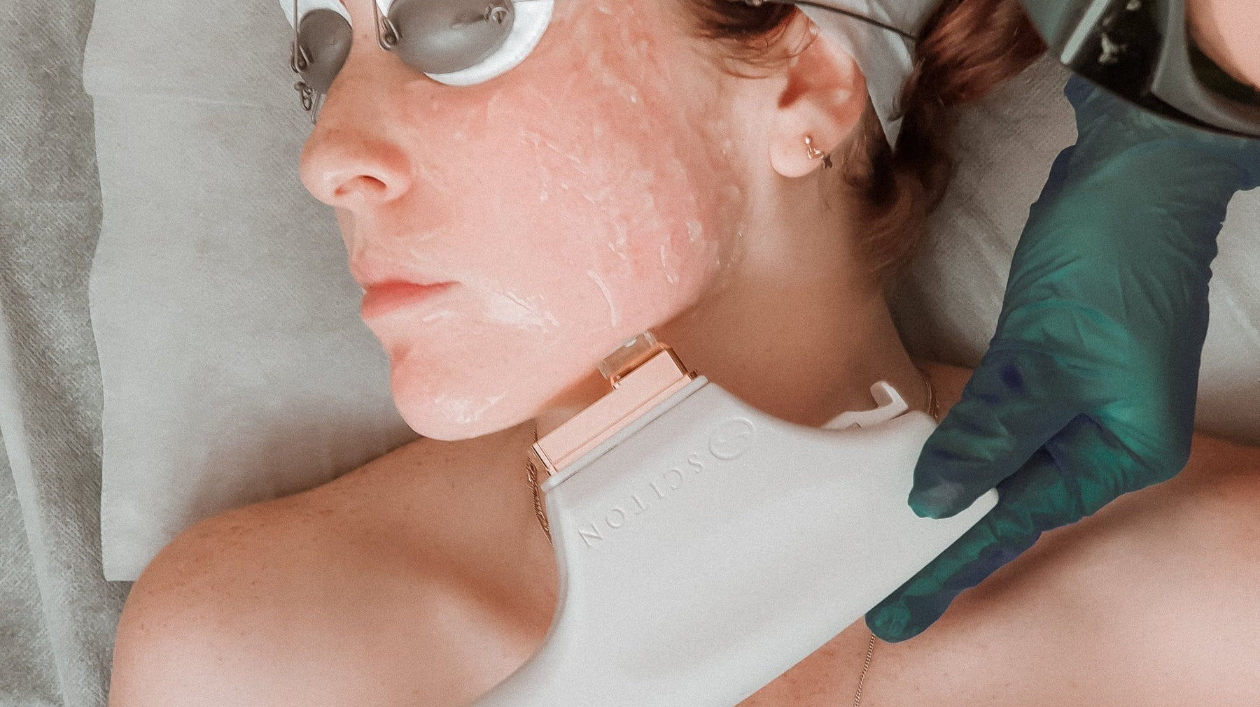 Laser For Rosacea: 8 Reasons Why It’ll Make You Feel Remarkable - The Skin Boutique