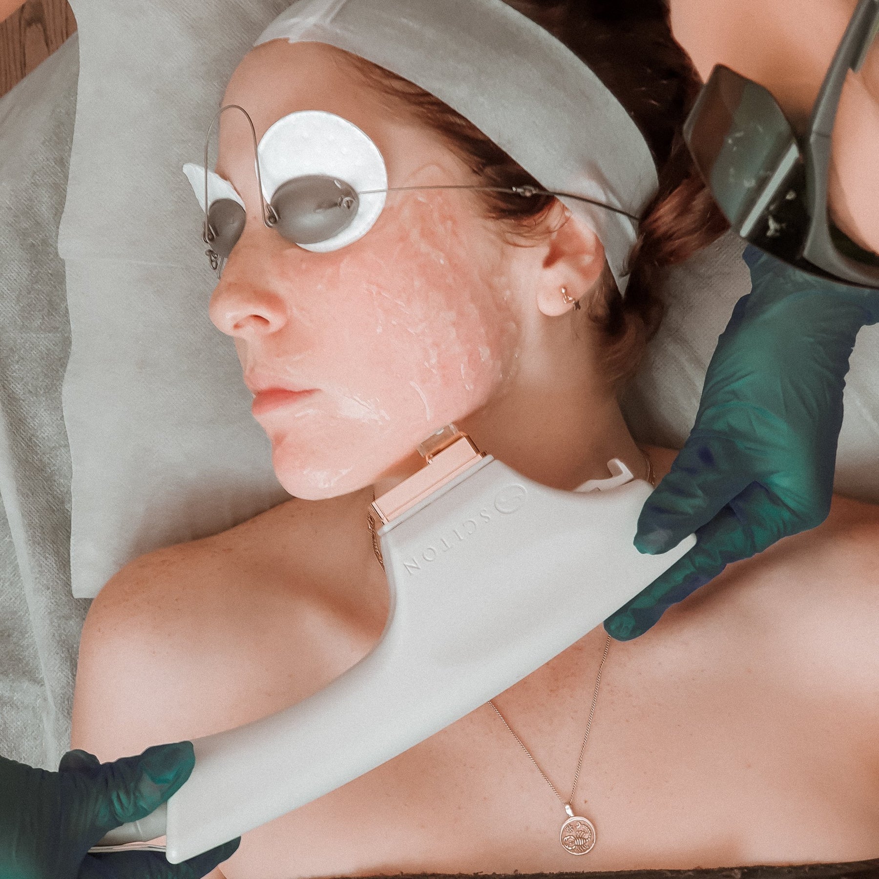 Laser For Rosacea: 8 Reasons Why It’ll Make You Feel Remarkable - The Skin Boutique