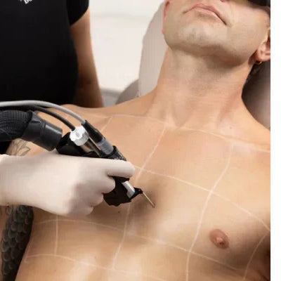Laser Hair Removal: Is It Permanent?