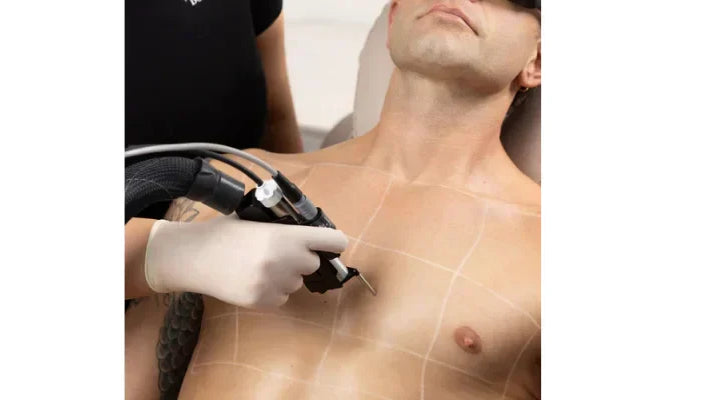 Laser Hair Removal: Is It Permanent?