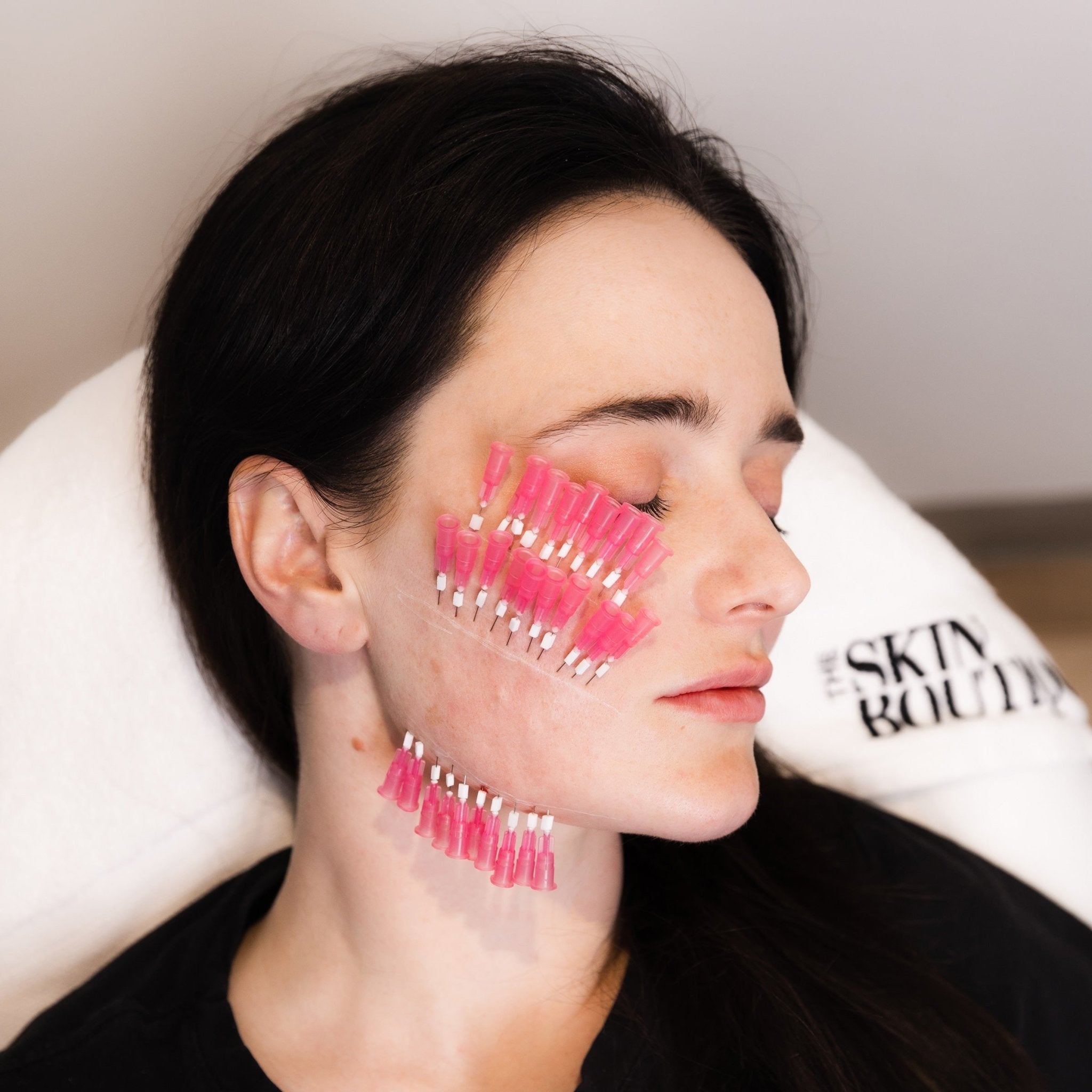 PDO Mono Threads - The Skin Boutique - Cosmetic Injections - The Skin Boutique