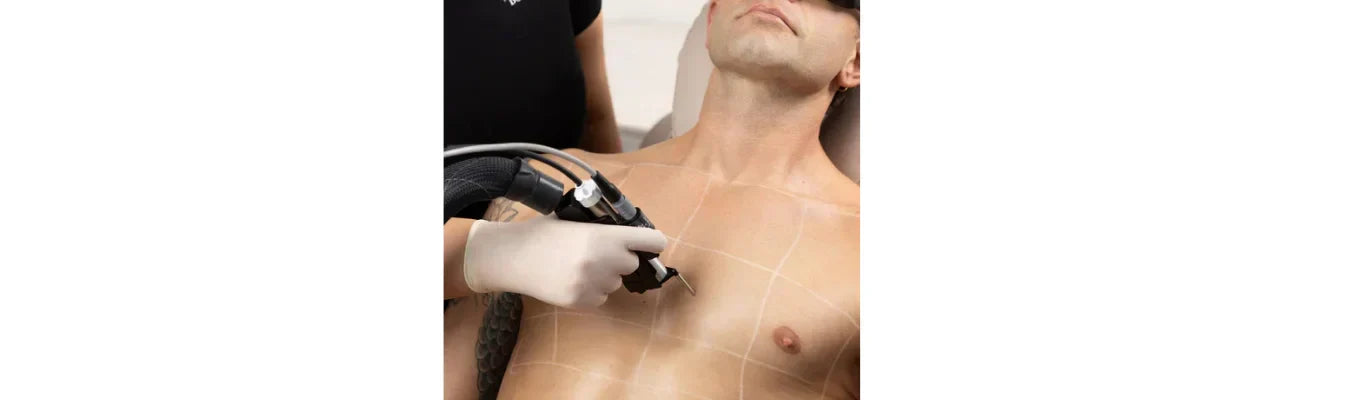 Laser Hair Removal: Is It Permanent?